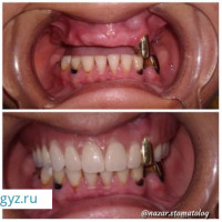 Стоматология тиш салуу тиш алуу БРЕКЕТЫ ПРОТЕЗЫ ИМПЛАНТАЦИЯ все стом услуги 15% скидка