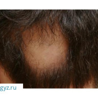 24/7 круглосуточно ✅ Дерматолог( лечение алопеции, кожные заболевания, бородавки, папилломы) ✔️